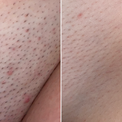 Ingrown Hair Oil - Nude